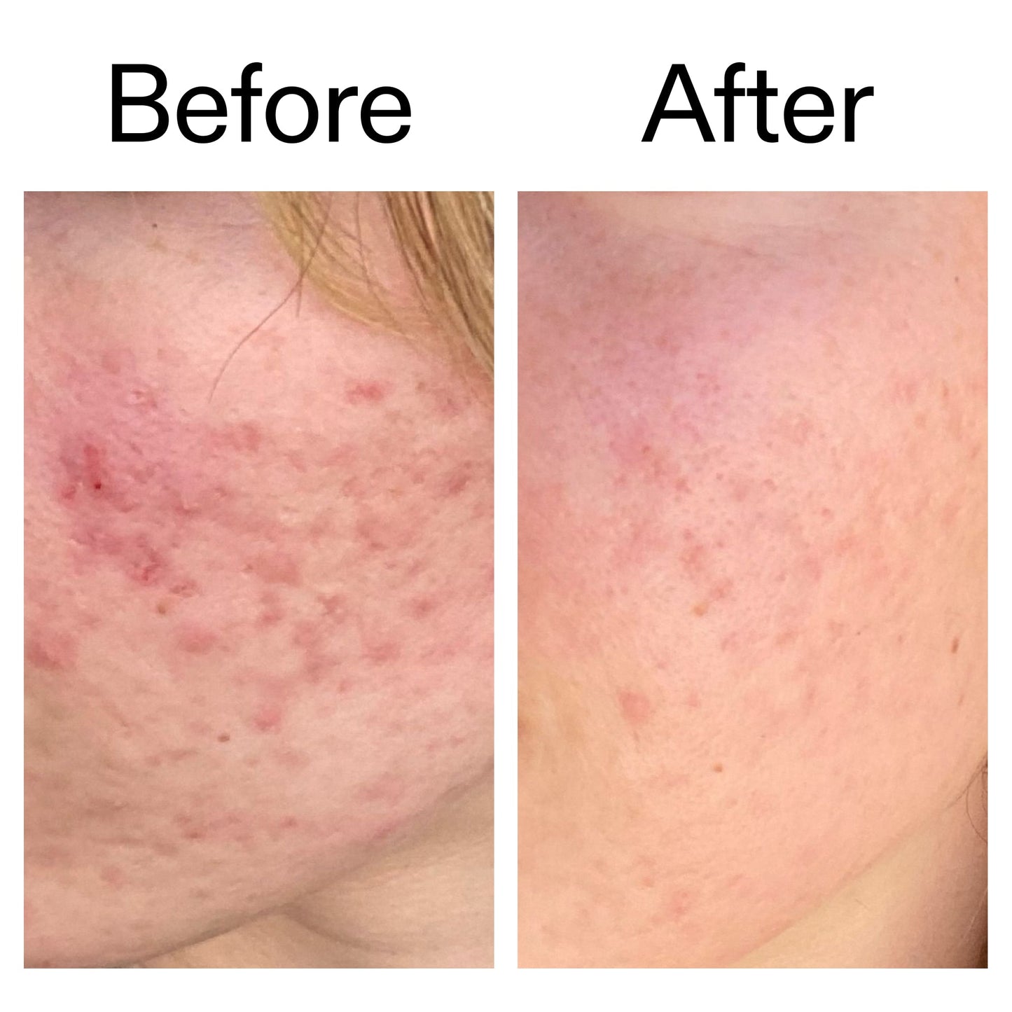 10-azelaic-acid-serum-for-redness-relief-y0 Azealic_Acid_Serum_B_A_Ppage_2000_x_2000.jpg