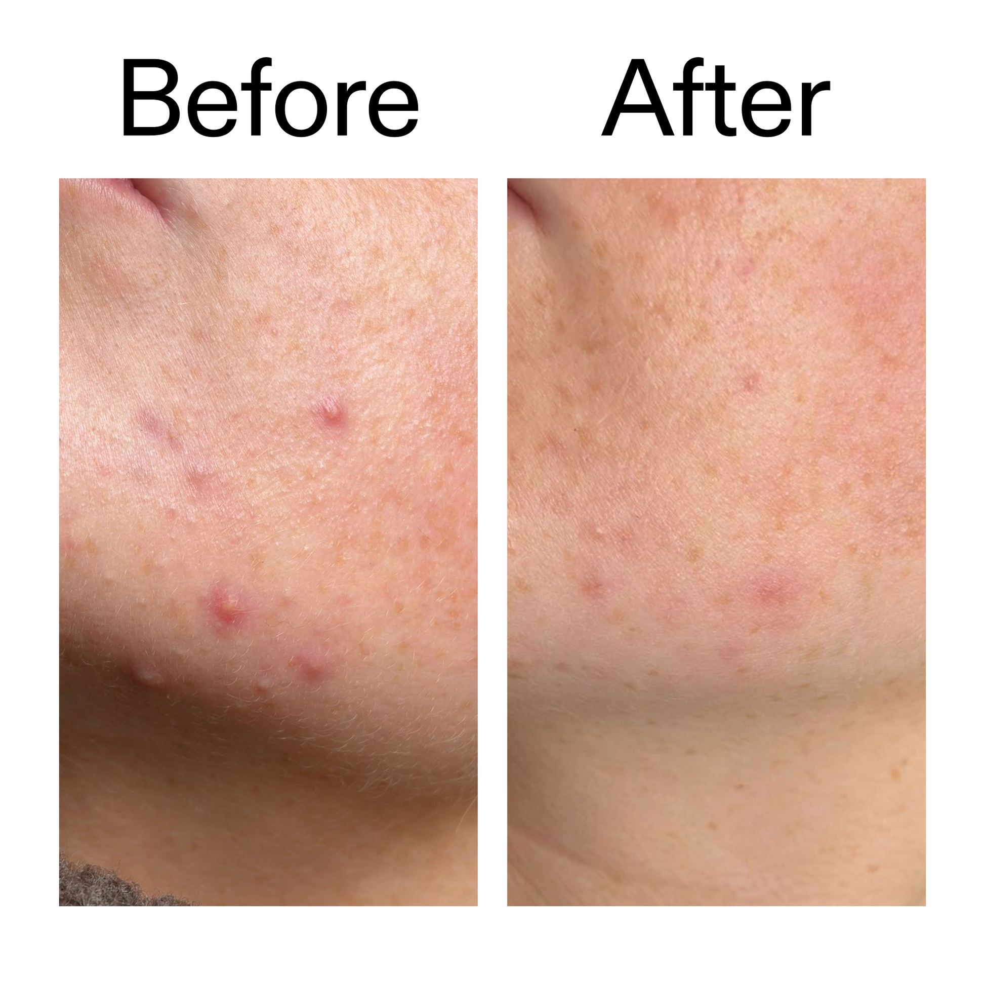 10-azelaic-acid-serum-for-redness-relief-y0 B_A_1_PPAGE.png