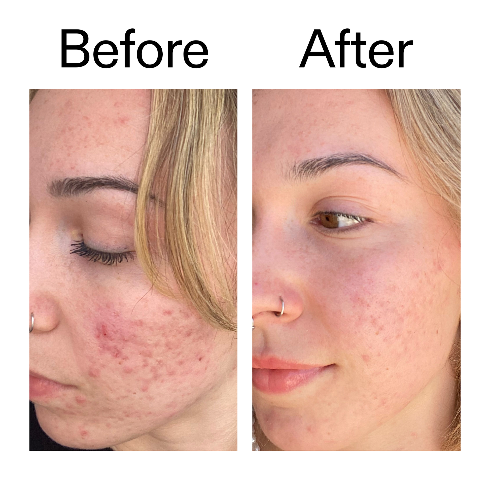 10-azelaic-acid-serum-for-redness-relief-y0 B_A_2_PPAGE.png