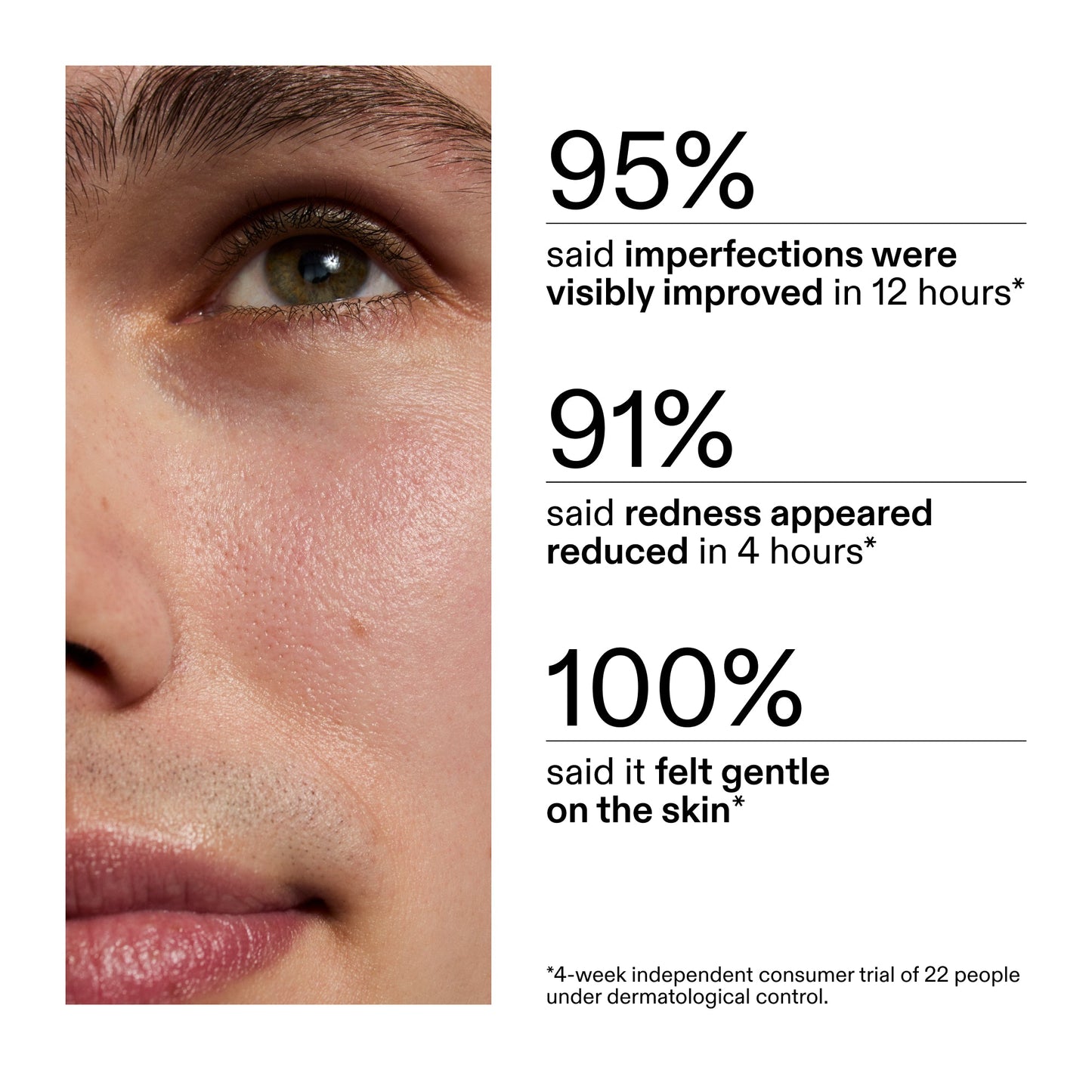 succinic-acid-acne-treatment-e0 CA_Succinic_Acid_Treatment_key_Claims_2000x2000_db91b0f1-7f29-4bfe-bb16-63a47f500960.jpg