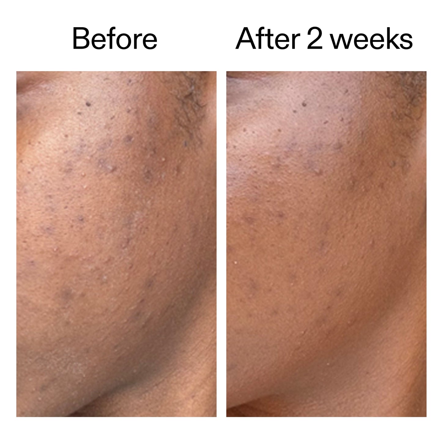 360-acne-clearing-duo-u3 DIOICB_A2000x2000.jpg