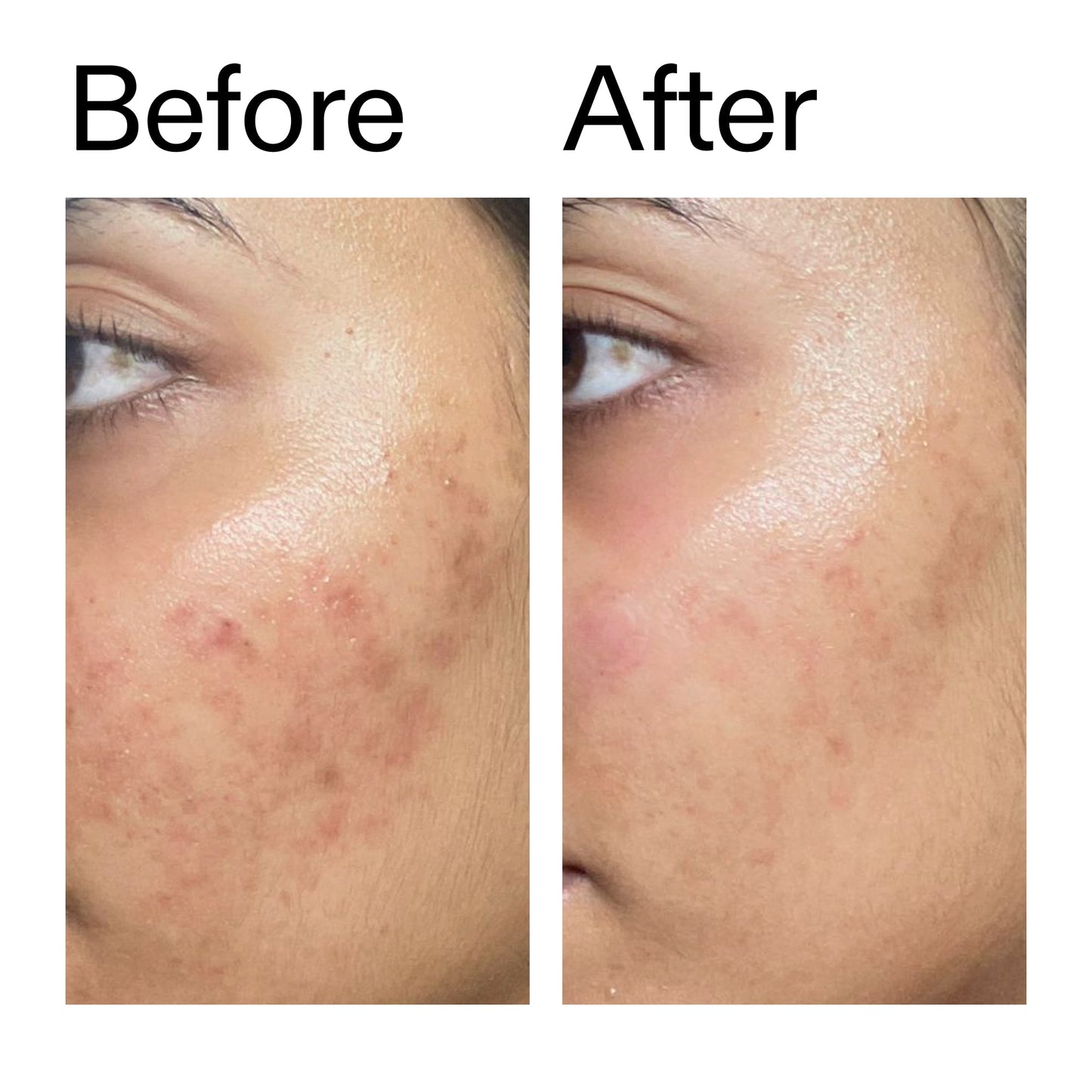 ectoin-hydro-barrier-serum-l7 Ectoin_Hydro-barrier_Serum__Before_After_2000x2000_34261920-d004-48d0-9c7b-8e1c15971bfd.jpg