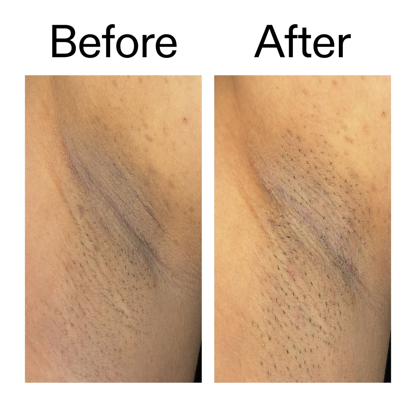glycolic-acid-exfoliating-body-stick-duo-v8 Glycolic_Acid_Exfoliating_Body_Stick_Before_After_V3_2000x2000_ea919cd9-1439-4a46-82a0-76200eb5bb42.jpg