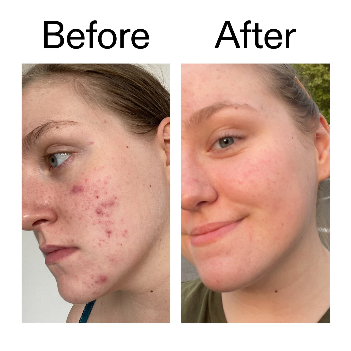 glycolic-acid-toner-n5 Glycolic_Acid_Toner_Before_After_2000x2000_49f0b9f7-e71b-4b2e-a8f8-2ea4b73247bb.jpg