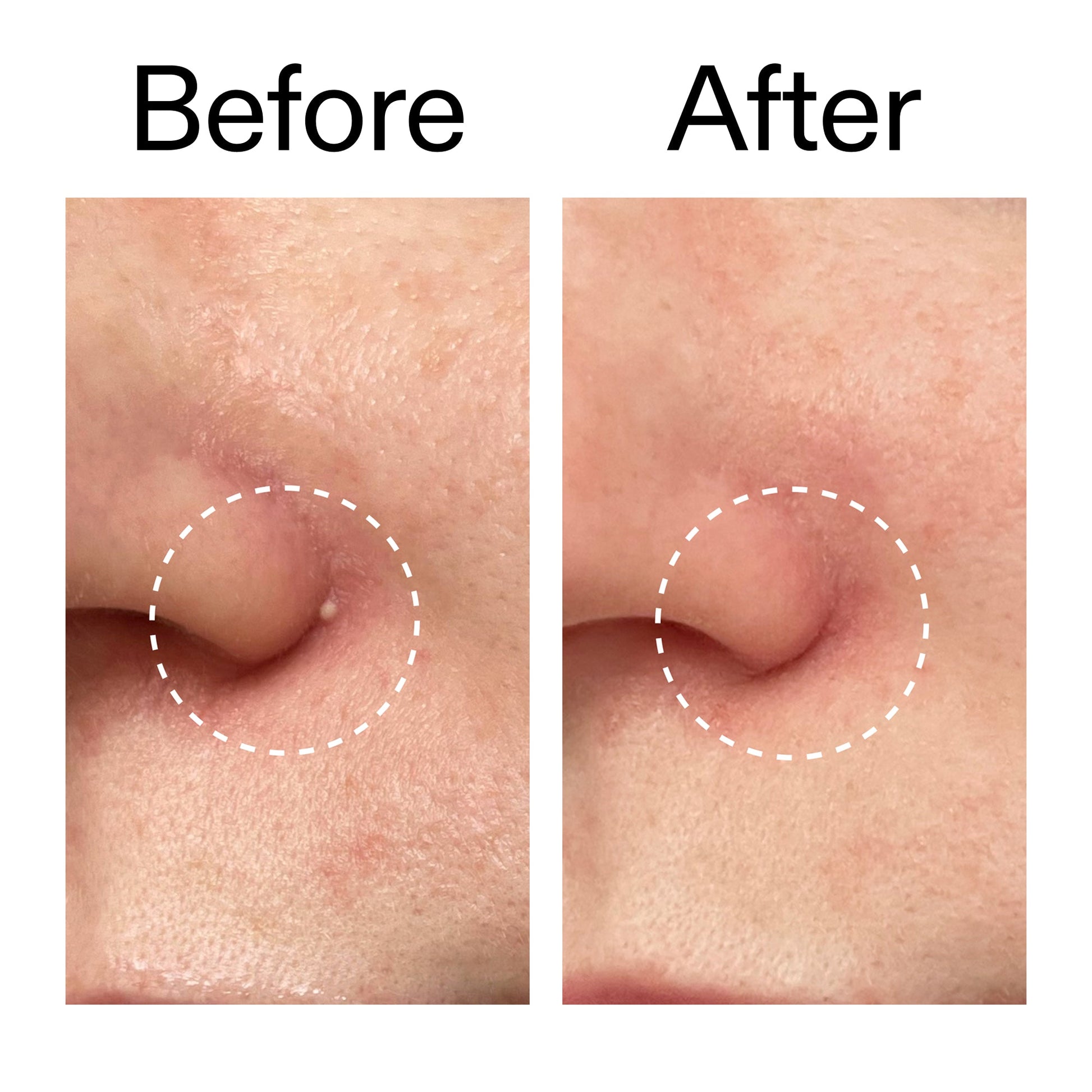 hydrocolloid-invisible-pimple-patches-pack-of-44-w3 Hydrocolloid_Invisible_Pimple_Patches_Before_After_2000x2000_b02aa37b-c78a-4682-91de-9135af5bb7df.jpg