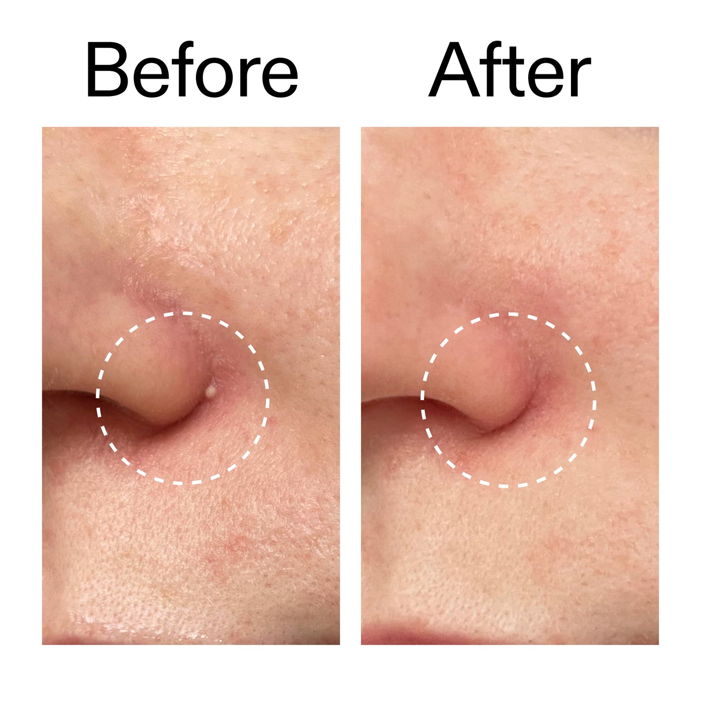 hydrocolloid-invisible-pimple-patches-pack-of-22-b8 Hydrocolloid_Invisible_Pimple_Patches_Before_After_2000x2000_b02aa37b-c78a-4682-91de-9135af5bb7df.jpg