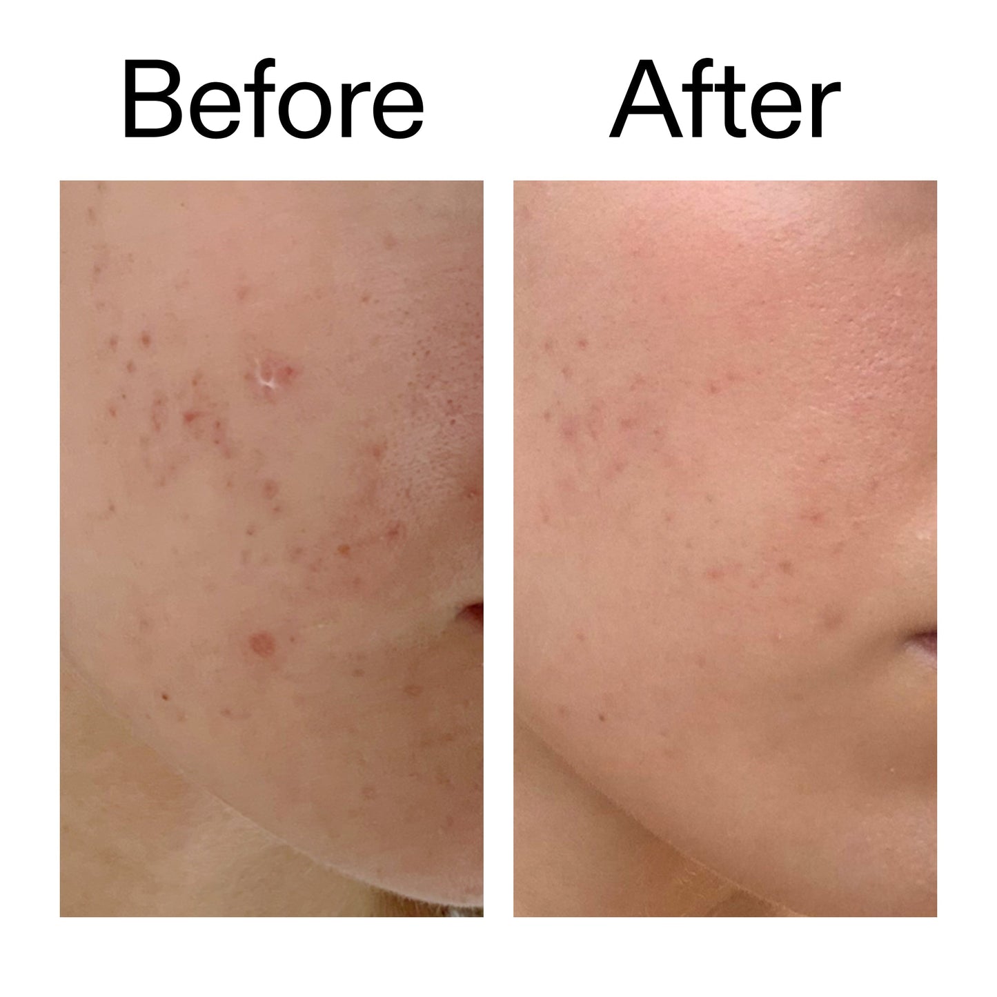 mandelic-acid-treatment-h2 Mandelic_Acid_Treatment_Before_After_2000x2000_4885ac6e-c5d7-4279-a72a-1417af7dce35.jpg