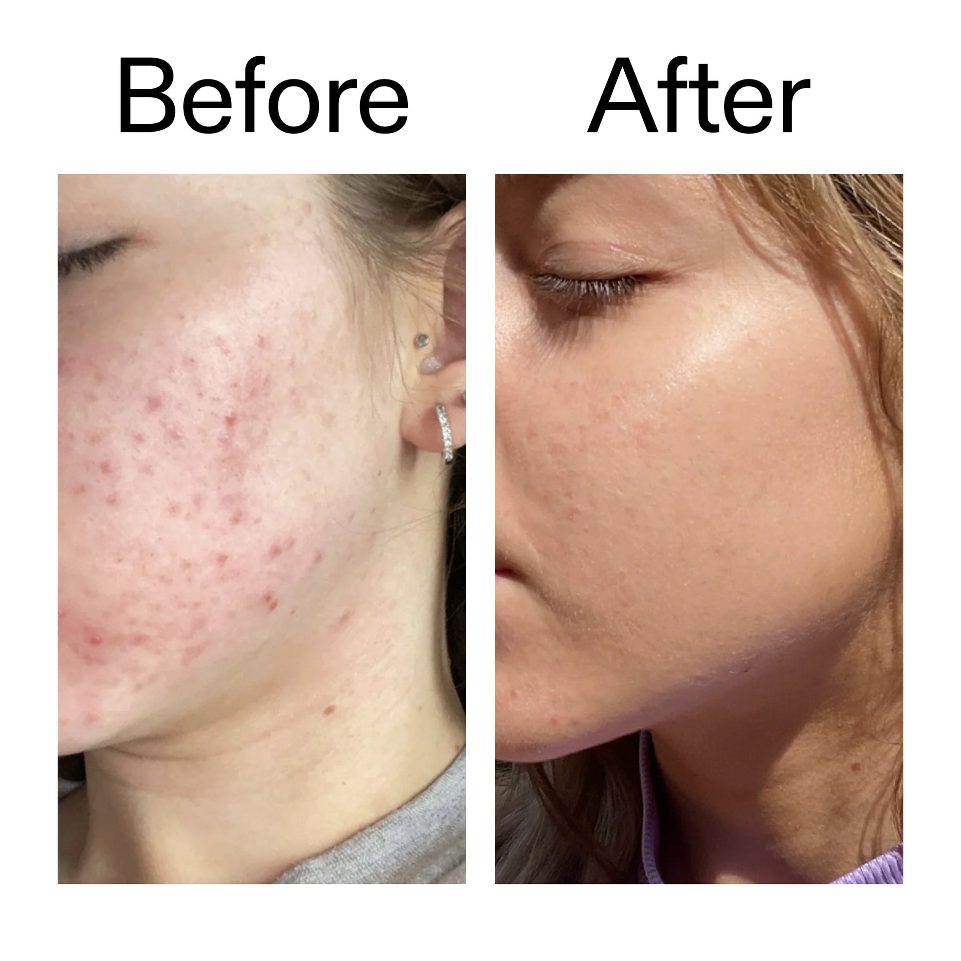 10-niacinamide-serum-duo-i0 Niacinamide_Serum_Before_After_2000x2000_bde32455-9e7d-448e-b053-bef41504f0a9.jpg