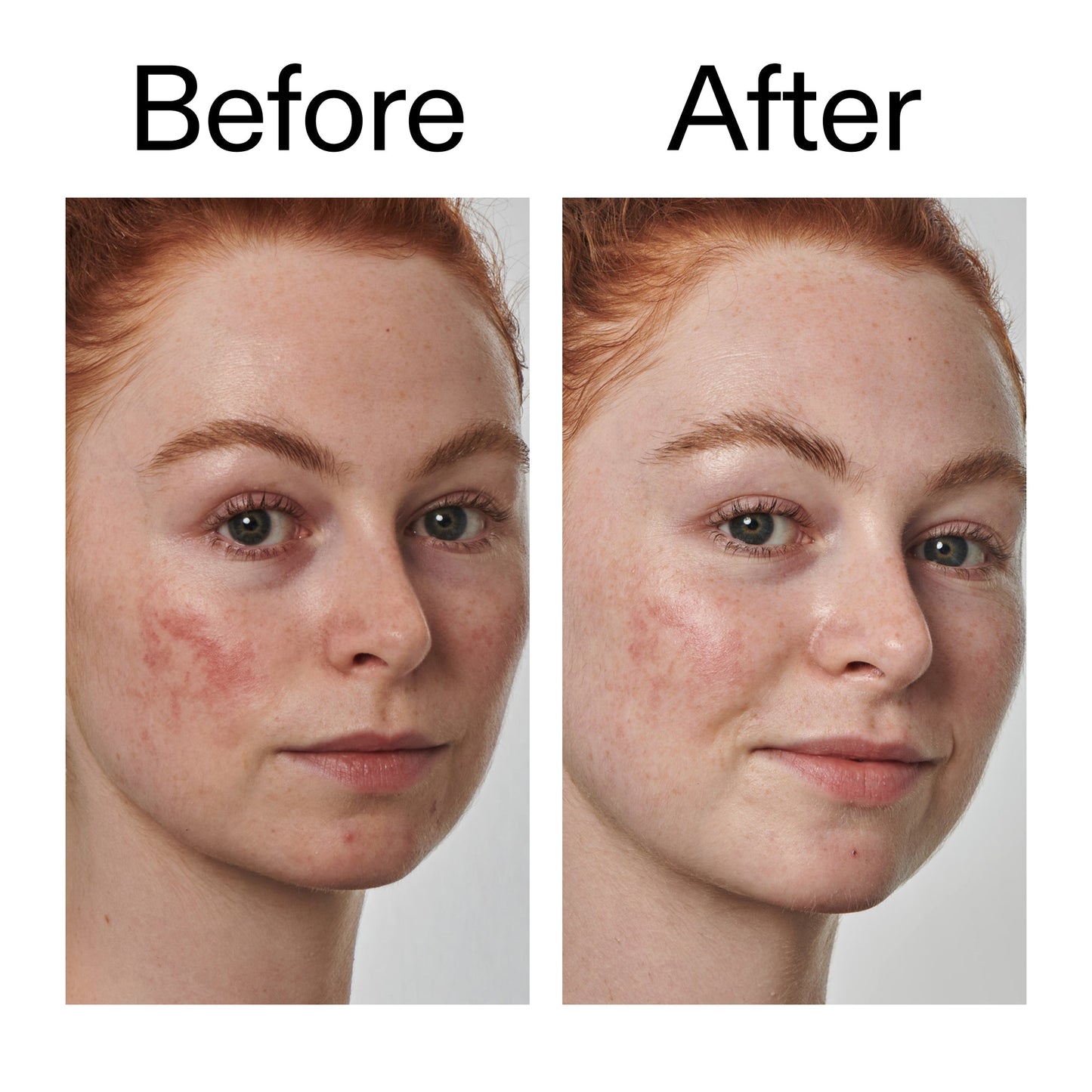 10-azelaic-acid-serum-for-redness-relief-y0 Redness_Relief_Serum_Before_After_2000x2000_3334dc9a-cce9-4e00-8aec-7ad89ca051f2.jpg