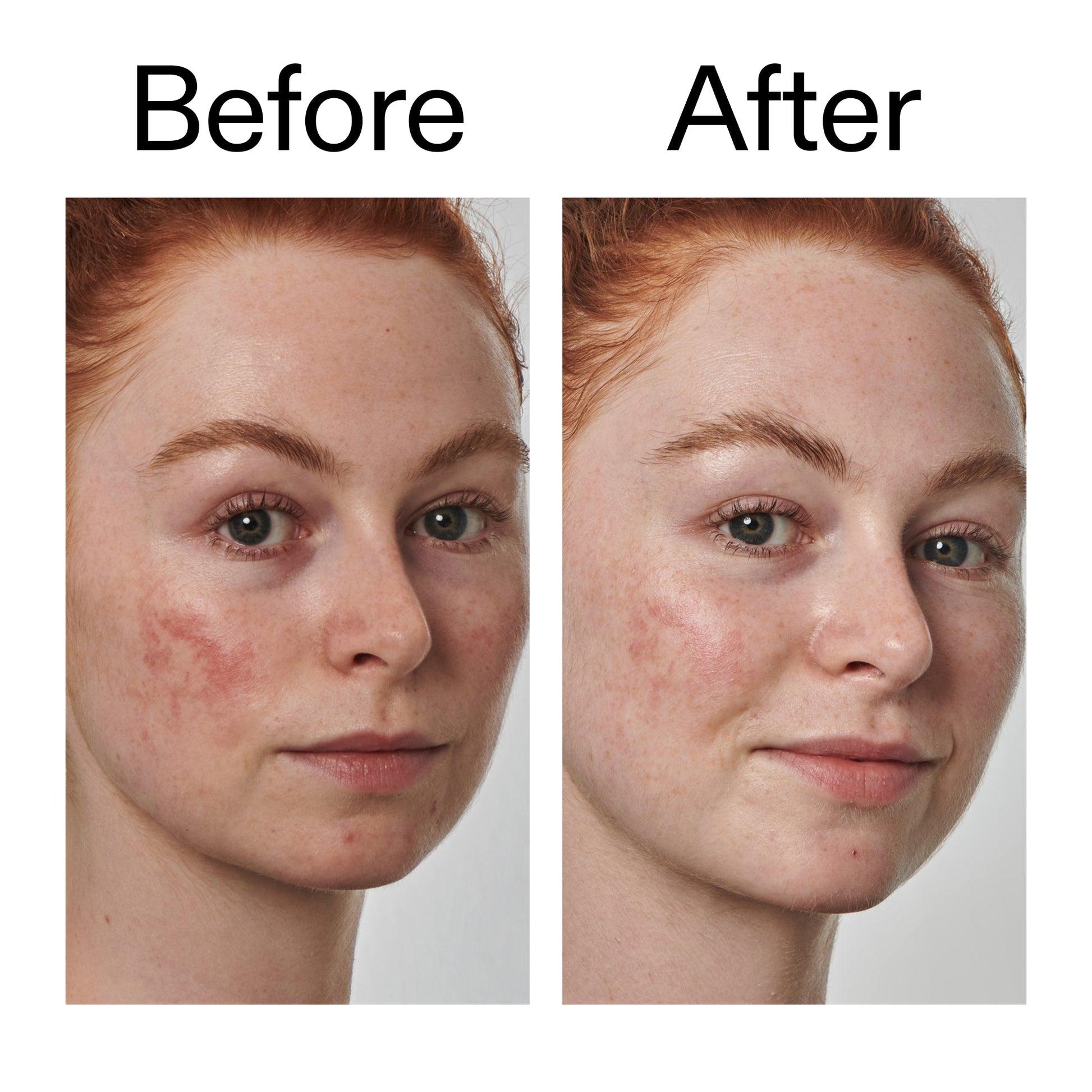 10-azelaic-acid-serum-for-redness-relief-y0 Redness_Relief_Serum_Before_After_2000x2000_3334dc9a-cce9-4e00-8aec-7ad89ca051f2.jpg