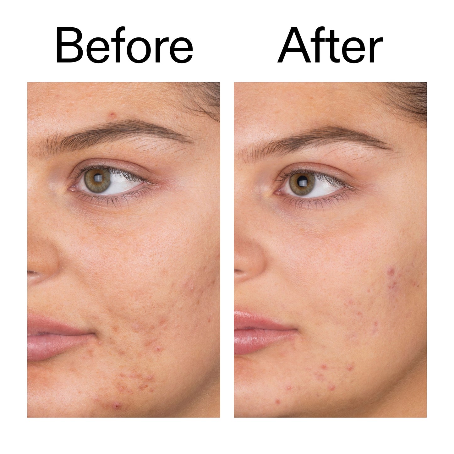 salicylic-acid-cleanser-150ml-c4 Salicylic_Acid_Cleanser_-_150ml_Before_After_2000x2000_e7230494-853f-4b07-82b1-27669104c995.jpg