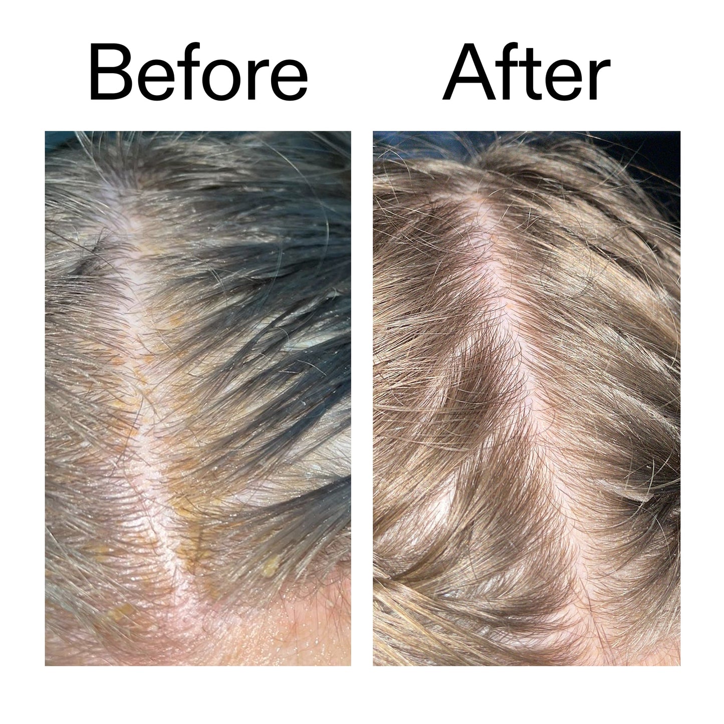 salicylic-acid-exfoliating-scalp-treatment-a7 Salicylic_Acid_Exfoliating_Scalp_Treatment_Before_After_2000x2000_e572a30f-057c-4a48-823b-1c09dc97f8d0.jpg