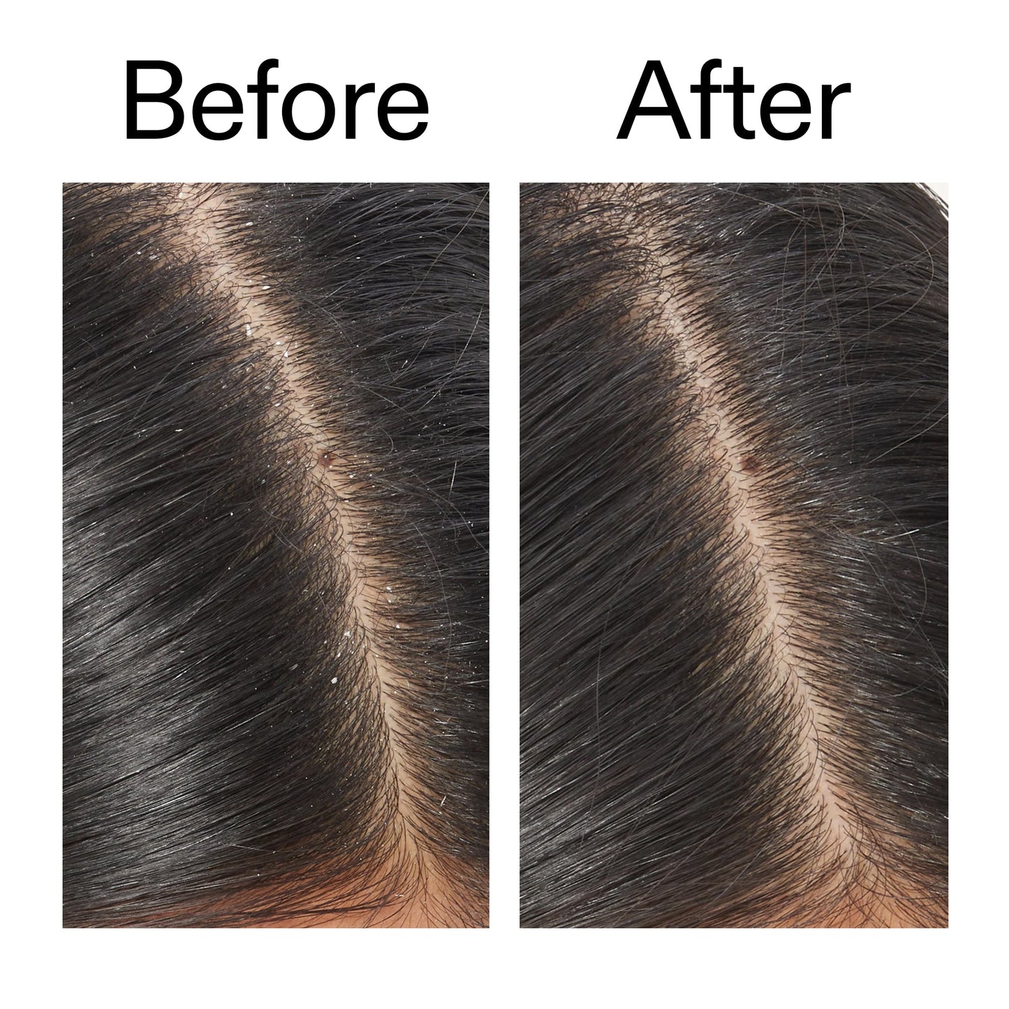 salicylic-acid-exfoliating-scalp-treatment-a7 Salicylic_Acid_Exfoliating_Scalp_Treatment_Before_After_V2_2000x2000_02bd61ad-42bf-490b-b3e3-7e04b2e8a673.jpg