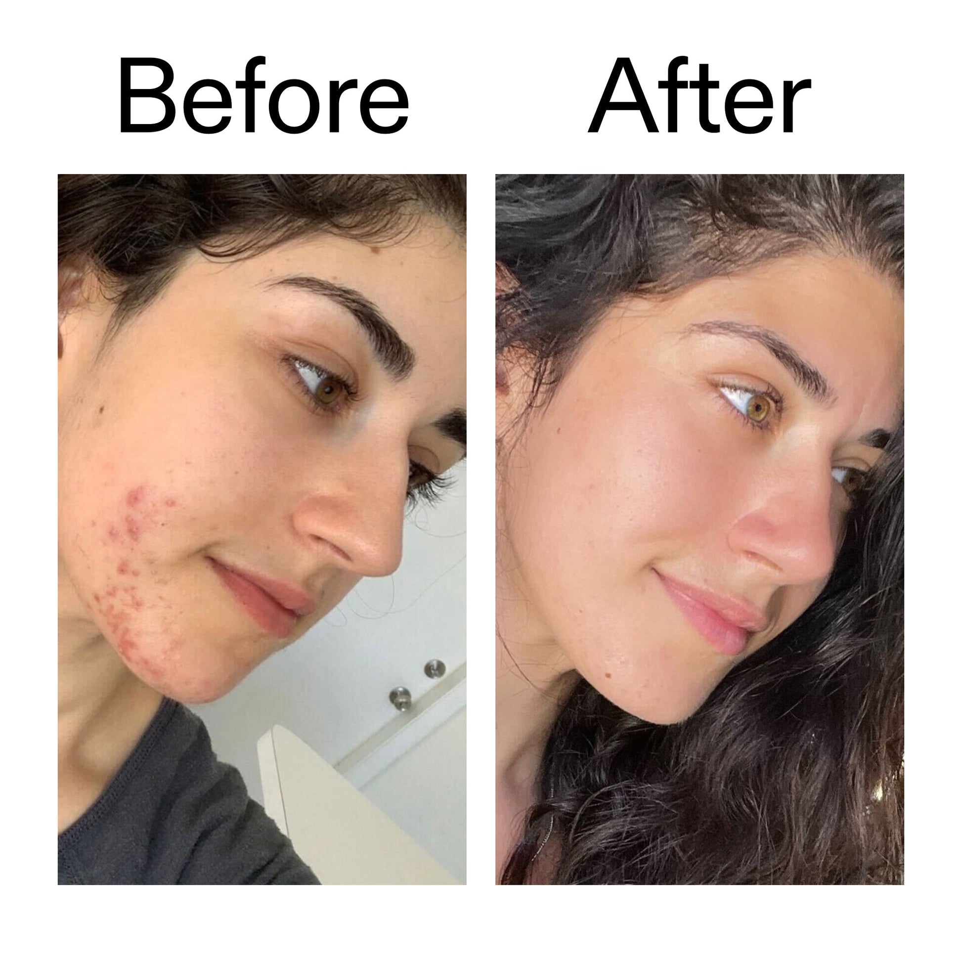 succinic-acid-acne-treatment-e0 Succinic_Acid_Treatment_Before_After_2000x2000_6a5f0054-2f58-4433-9314-0dc72c9bdd3b.jpg