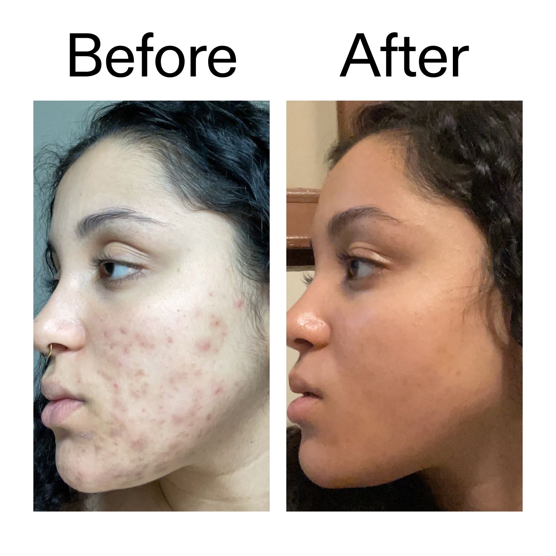 tranexamic-acid-serum-n2 Tranexamic_Acid_Serum_Before_After_2000x2000_98ebc8be-77b0-4843-8a22-90790ebe918b.jpg